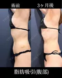 腹部脂肪吸引 before画像 サムネイル用