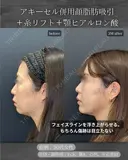 顔脂肪吸引、糸リフト、ヒアルロン酸注入(顎) before画像 サムネイル用