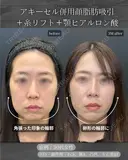 顔脂肪吸引、糸リフト、ヒアルロン酸注入(顎) after画像 サムネイル用