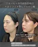 顔脂肪吸引、糸リフト、ヒアルロン酸注入(顎) after画像 サムネイル用