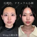 Wing小顔女神脂肪吸引 30日後 サムネイル用