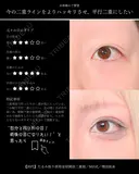 たるみ取り併用全切開法二重術/MD式/埋没抜糸 before画像 サムネイル用
