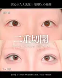 たるみ取り併用全切開法二重術/MD式/埋没抜糸 90日後 サムネイル用