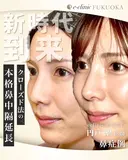 クローズド法での本格鼻中隔延長（鼻整形） after画像 サムネイル用