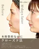 クローズド法での本格鼻中隔延長（鼻整形） before画像 サムネイル用