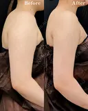 ベイザー併用アキーセル二の腕脂肪吸引 90日後 サムネイル用