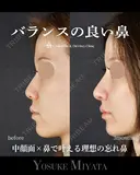 バランスの良い鼻 before画像 サムネイル用