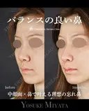 バランスの良い鼻 90日後 サムネイル用