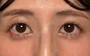 目のくぼみ改善！目の上ヒアルロン酸 before画像 サムネイル用