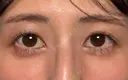 目のくぼみ改善！目の上ヒアルロン酸 0日後 サムネイル用