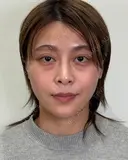 術後からスッキリ♪目の下クマ取り before画像 サムネイル用