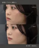 【涙袋】ヒアルロン酸注入 before画像 サムネイル用