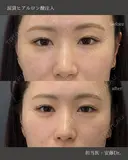 【涙袋】ヒアルロン酸注入 before画像 サムネイル用