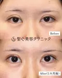 【20代女性・ハム目を治す】睫毛上皮膚切除（術後1ヶ月） 30日後 サムネイル用
