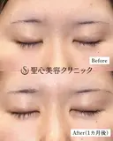 【20代女性・ハム目を治す】睫毛上皮膚切除（術後1ヶ月） after画像 サムネイル用