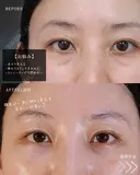 クマ取りでここまで変わる‼ before画像 サムネイル用