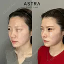 鼻尖形成・軟骨移植・鼻背部軟骨移植・鼻柱下降術 after画像 サムネイル用
