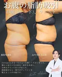 ウエスト－10㎝✨ before画像 サムネイル用