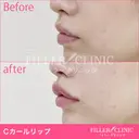 【Cカールリップ👄】スマイルリップ+人中短縮ヒアル before画像 サムネイル用
