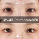 目尻切開＋グラマラス形成（切開） 30日後 サムネイル用