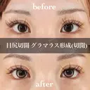 目尻切開＋グラマラス形成（切開） 30日後 サムネイル用