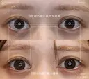 【20代女性・目頭と目尻の相乗効果で目を大きく】目頭切開＋目尻切開（1ヶ月後） 30日後 サムネイル用