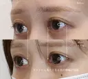 【20代女性・目頭と目尻の相乗効果で目を大きく】目頭切開＋目尻切開（1ヶ月後） 30日後 サムネイル用