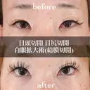 目頭切開＋目尻切開＋白眼拡大術（結膜切開） 30日後 サムネイル用
