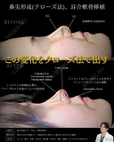 【鼻整形】鼻尖形成クローズ法＋耳介軟骨移植 before画像 サムネイル用
