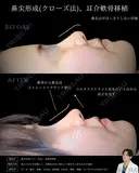 【鼻整形】鼻尖形成クローズ法＋耳介軟骨移植 after画像 サムネイル用