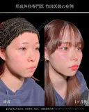 小顔脂肪吸引(頬+あご下+エラ下+ジョールファット)/鼻尖形成3D法/軟骨移植/MD式/ before画像 サムネイル用