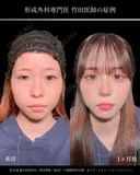 小顔脂肪吸引(頬+あご下+エラ下+ジョールファット)/鼻尖形成3D法/軟骨移植/MD式/ 30日後 サムネイル用