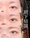 眉下切開/MD式 30日後 サムネイル用