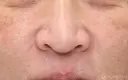 【50代女性・自然な小鼻に】小鼻縮小術（1ヶ月後） before画像 サムネイル用