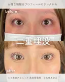 二重埋没法 after画像 サムネイル用