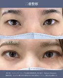 自信の持てる目元に🦋 ネビュラクリニックの二重埋没法💫 after画像 サムネイル用