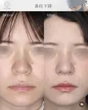 鼻柱下降 after画像 サムネイル用