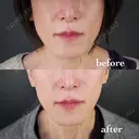 糸リフト before画像 サムネイル用