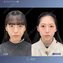 あごのバランスで変わる美しさ✨あごヒアルロン酸＆ボトックス 14日後 サムネイル用