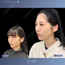 あごのバランスで変わる美しさ✨あごヒアルロン酸＆ボトックス 14日後 サムネイル用
