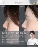 鼻柱下降　 before画像 サムネイル用