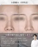 小鼻縮小 before画像 サムネイル用