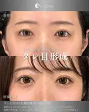 タレ目・目尻切開 after画像 サムネイル用