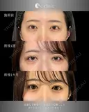 タレ目・目尻切開 before画像 サムネイル用