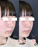 顎のヒアルロン酸 after画像 サムネイル用