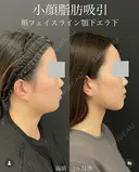 顔の脂肪吸引 before画像 サムネイル用