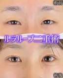 二重埋没 30日後 サムネイル用