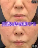 貴族フィラー×ほうれい線ヒアルロン酸 before画像 サムネイル用