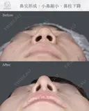 鼻尖形成　小鼻縮小　鼻柱下降 after画像 サムネイル用