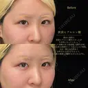 涙袋ヒアルロン酸 before画像 サムネイル用